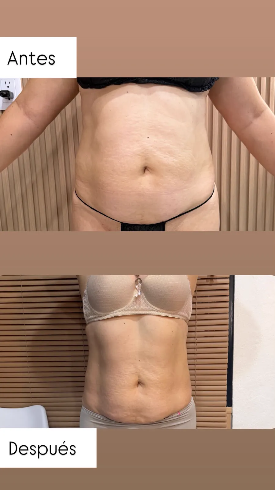 Abdomen, vista frontal
