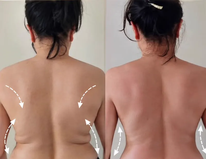 Espalda, antes y después