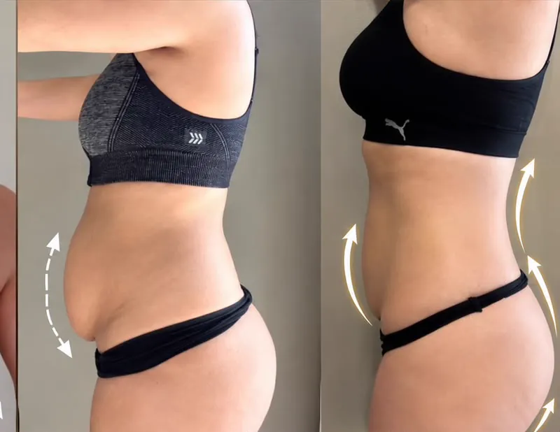 Abdomen, antes y después