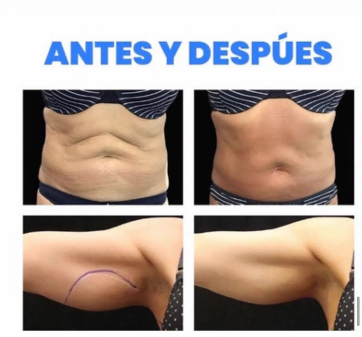 Abdomen y brazo